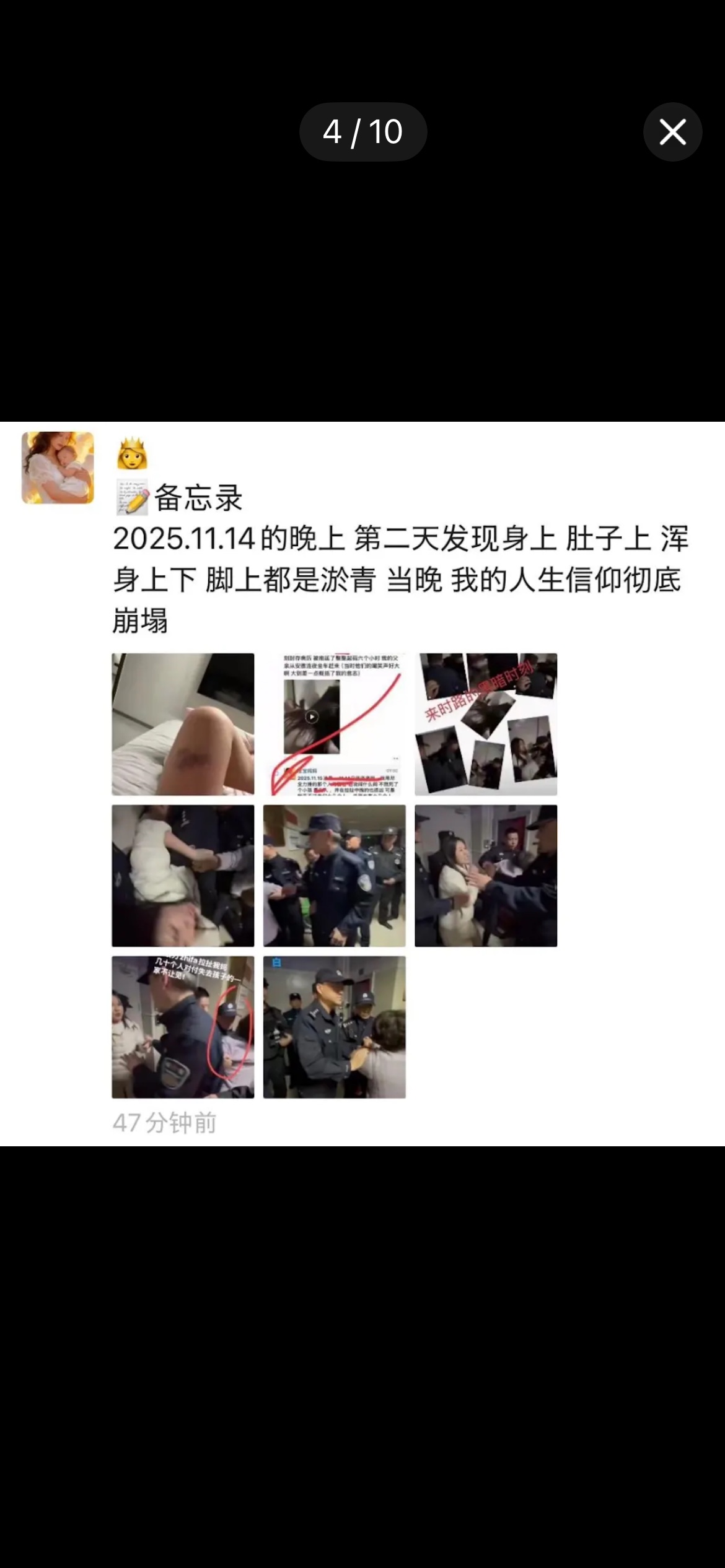 朋友圈截图：正文写2025年11月14日的晚上、第二天发现身上肚子上浑身上下脚上都是淤青、当晚人生信仰彻底崩塌；配八张图，包括淤青照片、备忘记录截图与多张现场画面